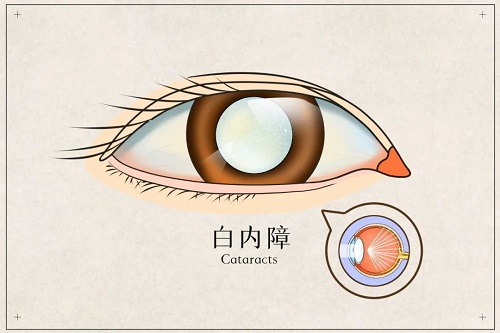 【健康科普】视线模糊不清？当心患上白内障